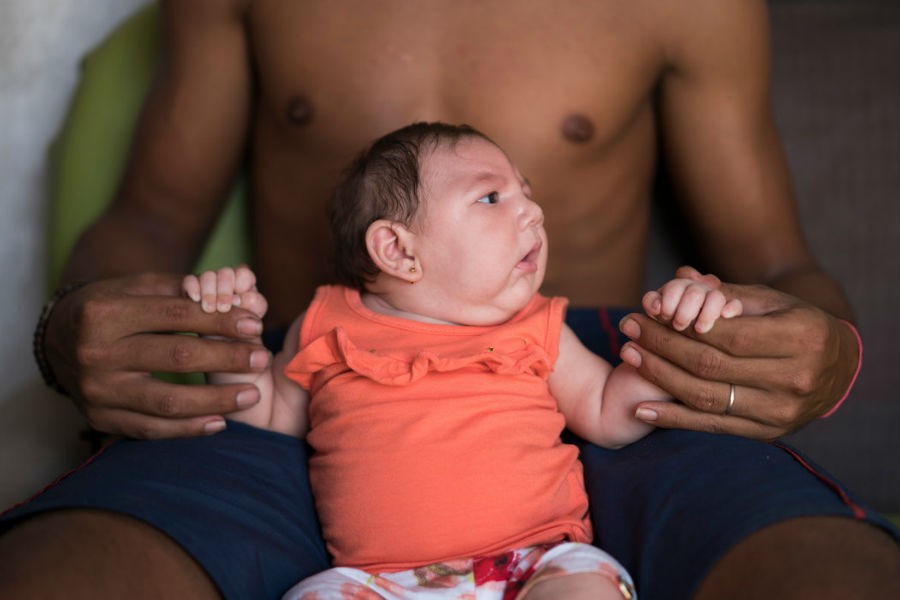 Luiza, a Brazilian baby, was born with microcephaly, which has been linked to the Zika virus.